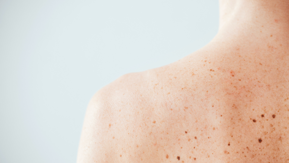 How many moles is deemed a high risk of skin cancer? | Solbari UPF 50+